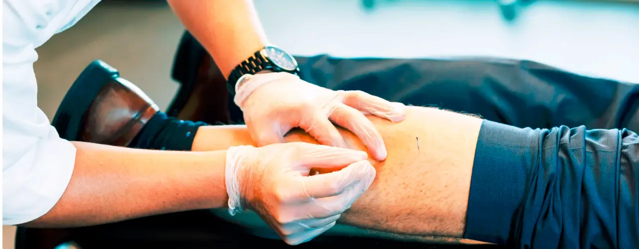 Close-up of dry needling in the lower leg